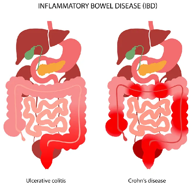 兩類發炎性腸道疾病的發炎區域