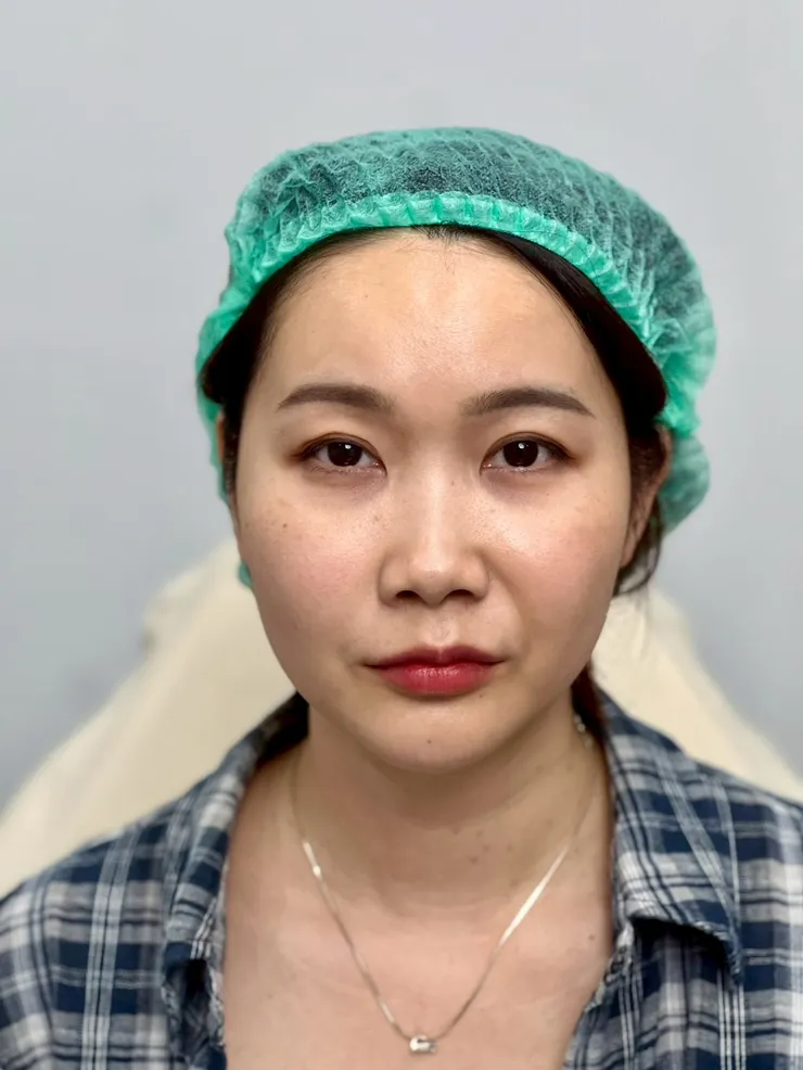 泰國曼谷醫美體驗|曼谷音波拉提推薦?泰國醫美諮詢流程與中文服務心得Best Friend Clinic