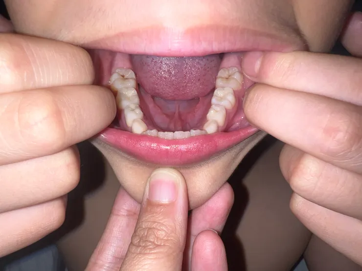 張大嘴，照下面，有時需要第三隻手幫忙，拉開下唇