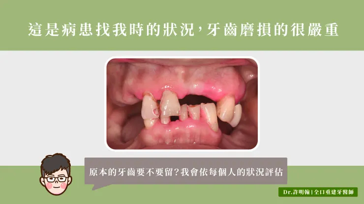 病患的牙齒磨損得很嚴重，要不要留？