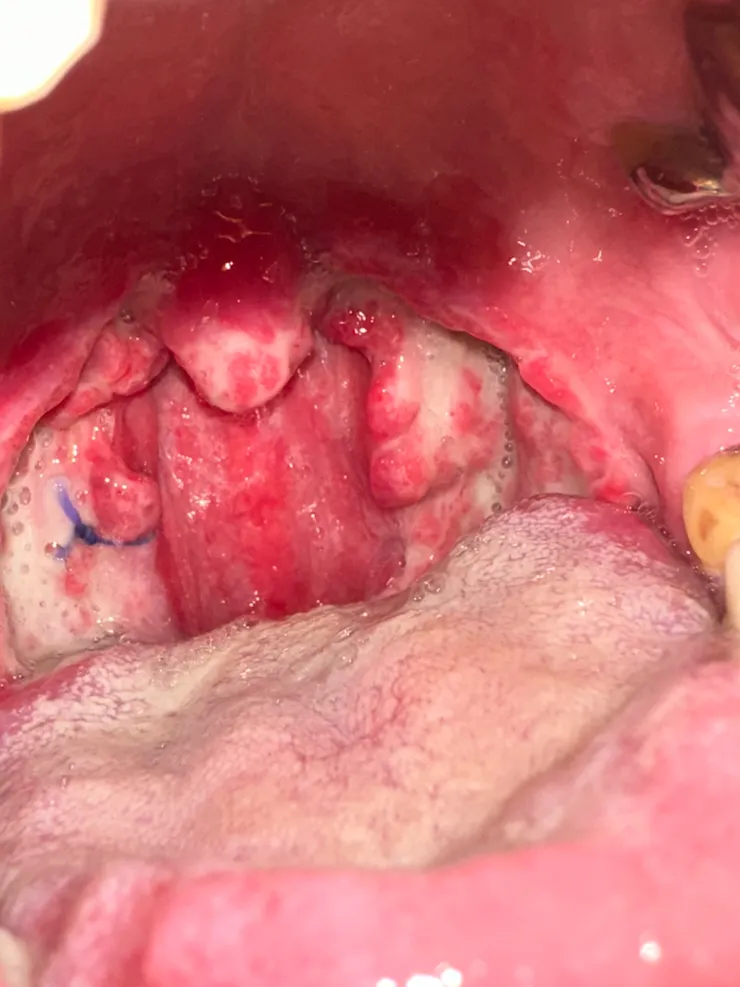 只剩下腫脹 縫線會自行吸收