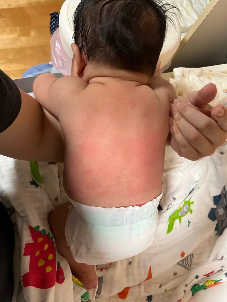 在換了啟賦水解後，希希的紅疹問題依舊