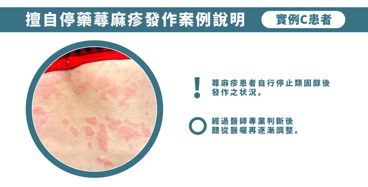 擅自停藥蕁麻疹發作案例說明-患者C