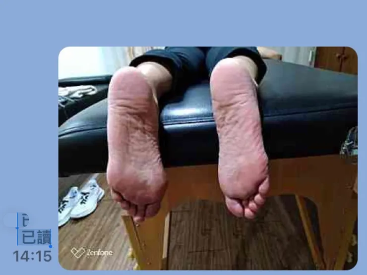 圖四:邱媽媽1130803日的雙腳底(偏扁平)