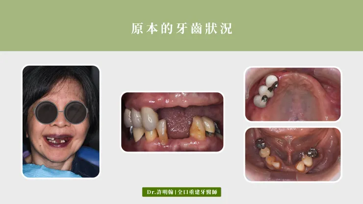 活動假牙病患原本的牙齒狀況