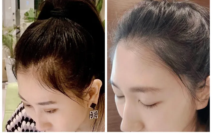 再一張比較正面的 原本髮際線是M字型 現在快變圓弧了