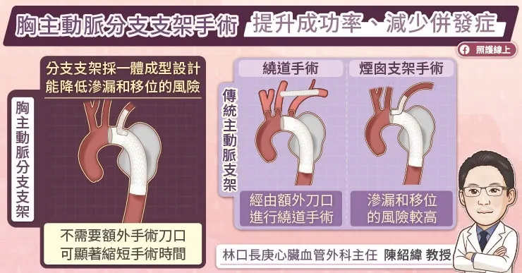 胸主動脈分支支架手術提升成功率