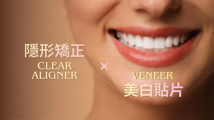 《渥爾1+1複合式療程》隱形矯正+牙齒貼片!一次搞定牙齒排列與美學,打造專屬你的完美笑容!