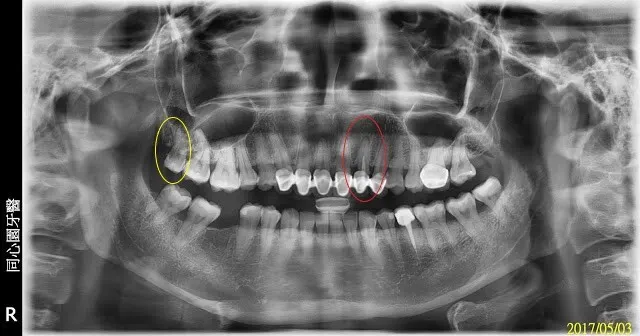 初診的病人，我都會照環口X光片檢查，像掃描，一次就可看到多數問題，所以我初診會講解很久很多，不會只針對主訴（主要的問題），請把握