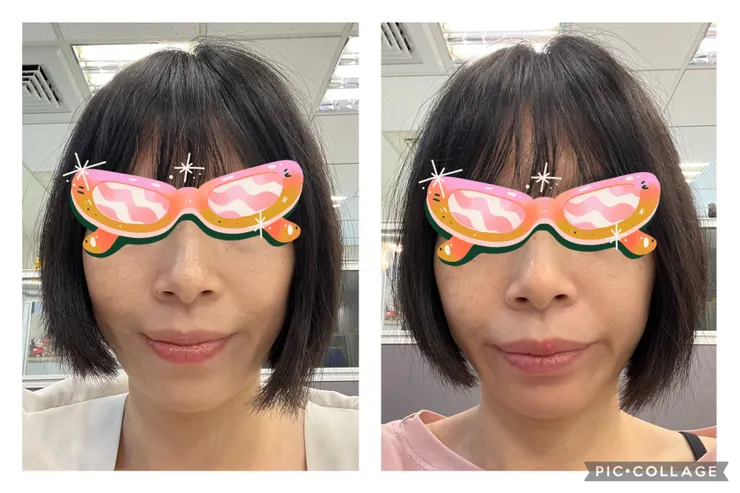 請忽略右邊明顯的水泡。