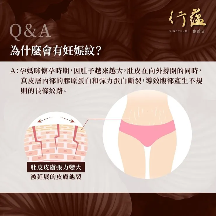 行蘊QA｜什麼是妊娠紋
