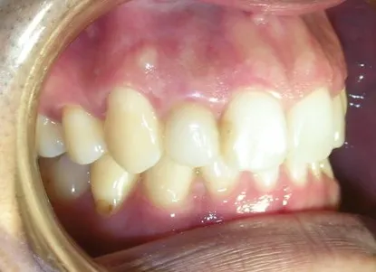 渥爾牙醫診所：Cap-Lock全瓷牙冠安裝，回診、追蹤！