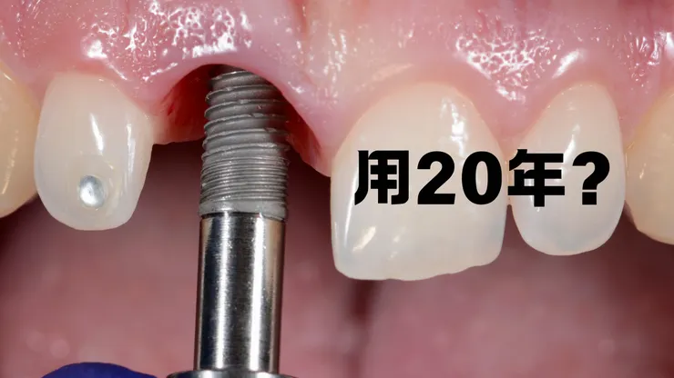 【植牙長壽祕訣】植牙後就一勞永逸？小心植體周圍炎！醫師：做好這三步，才能用一輩子！