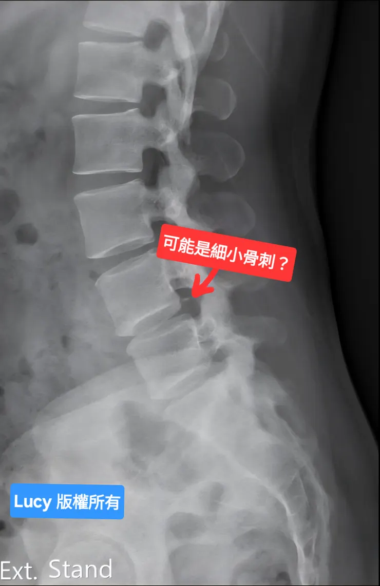 X 光影像醫生說疑似有長小骨刺？