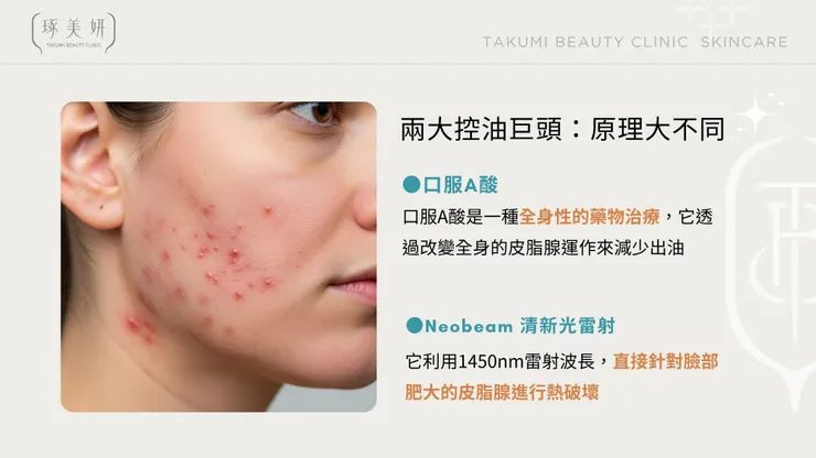 Neobeam 清新光 vs. 口服 A 酸：除了吃藥，你還有更溫和的控油選擇