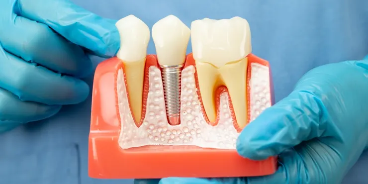 2026 植牙全攻略！解析價格、後遺症預防到成功案例，助您重拾自信笑容