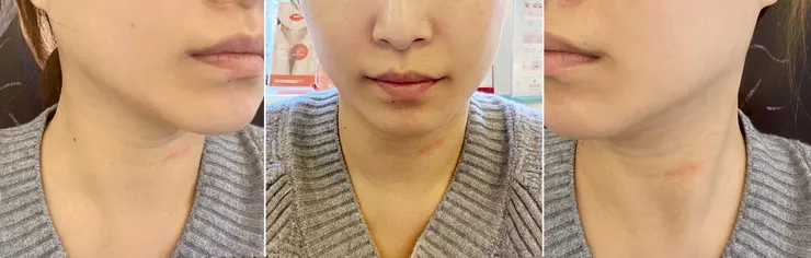 台北打雙下巴│ONDA超微波（昂達），台北醫美診所推薦【旭彤診所】