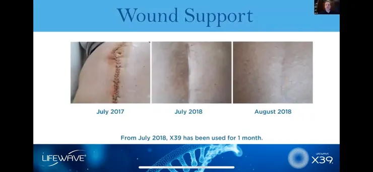 傷口支持 從2018年7月開始使用X39, 一個月後成果