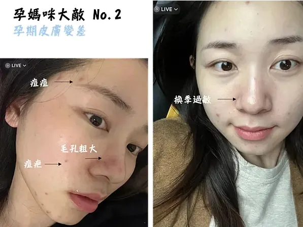 懷孕皮膚變差怎麼辦