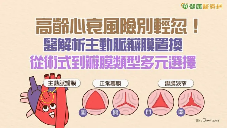 主動脈瓣膜狹窄,七成以上與老化相關,2至3成是雙葉主動脈瓣等先天性原因。