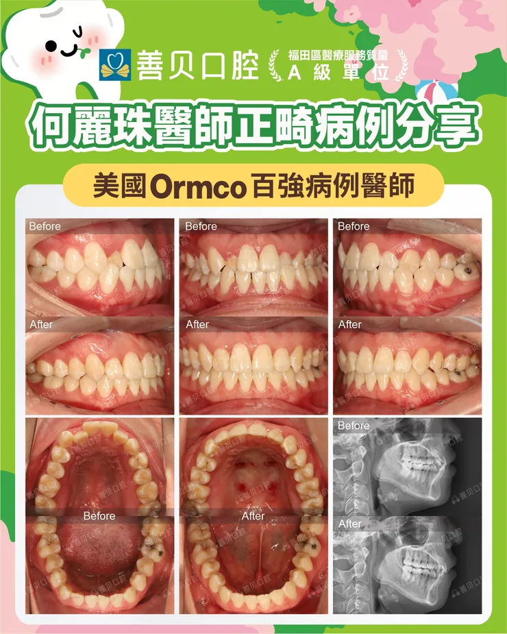 深圳正畸醫師何麗珠箍牙病例