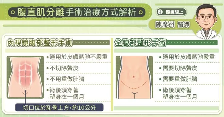 腹直肌分離手術治療的方式