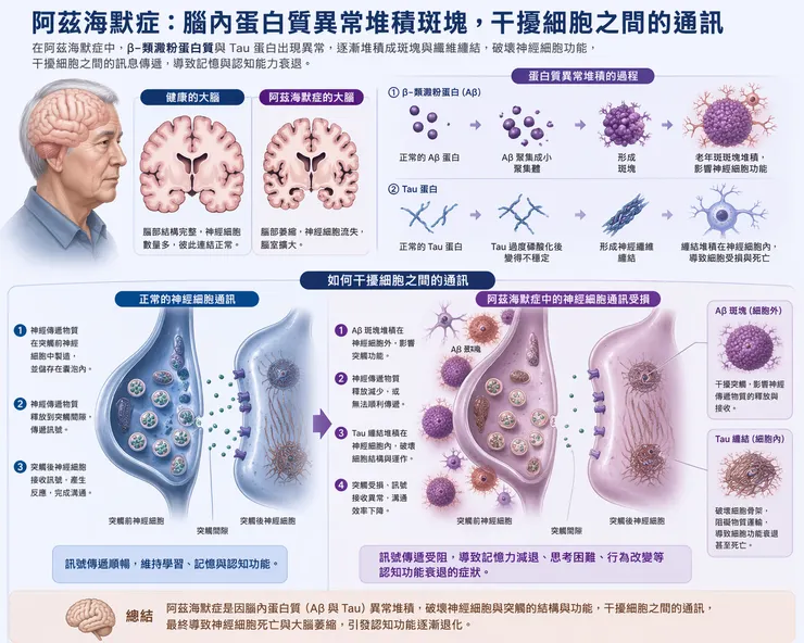 阿茲海默症因腦內蛋白質異常堆積,干擾細胞間的通訊,導致大腦神經細胞的凋亡與大腦萎縮,外顯出認知功能的退化