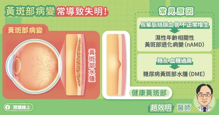 黃斑部病變常導致失明