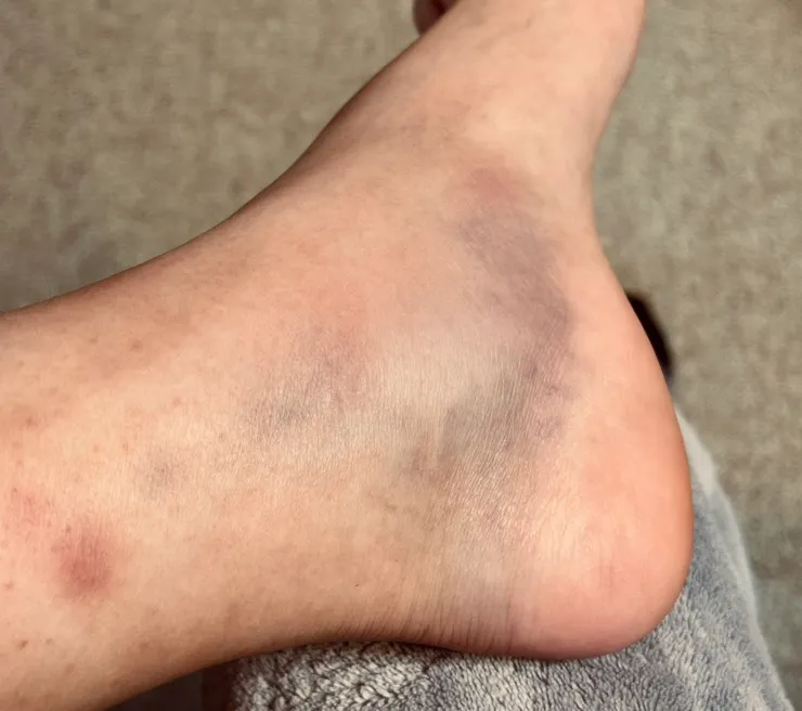 這是我腳踝扭傷的樣子。希望我的親身康復經驗能幫助你加快復原進度！