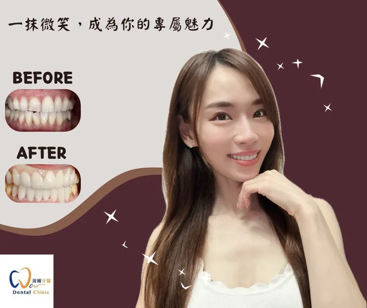笑容蛻變日記!蔣小姐的笑容大改造!渥爾牙醫診所「明眸鋯齒」牙齒美白貼片讓你擁有自信笑容!