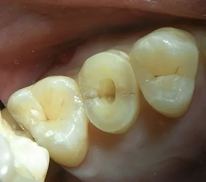 渥爾牙醫診所：小臼齒裂牙不拔牙，Cap-Lock全瓷修復保住原牙！