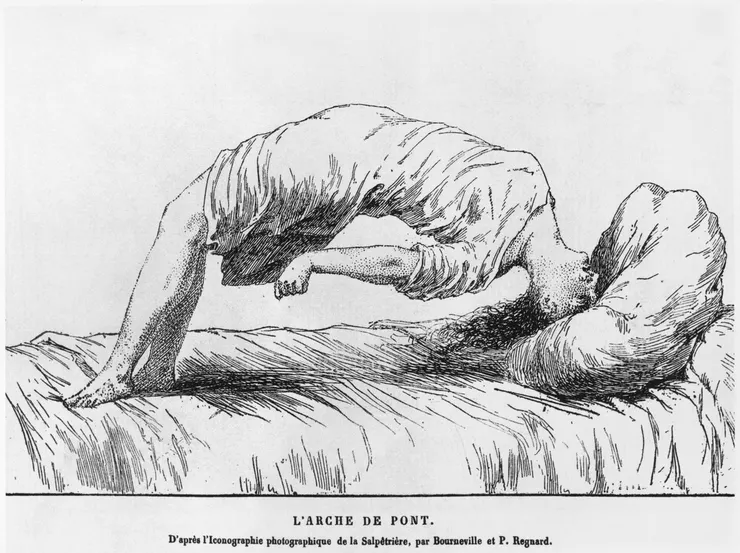 十九世紀法國內科醫師保羅雷尼亞 1884 年的醫學著作《心靈之傳染病》當中收錄的插畫《歇斯底里與夢遊症》 （Hysteria and Somnambulism, from Les Maladies Epidemiques de l'Esprit by Paul Regnard, 1884）