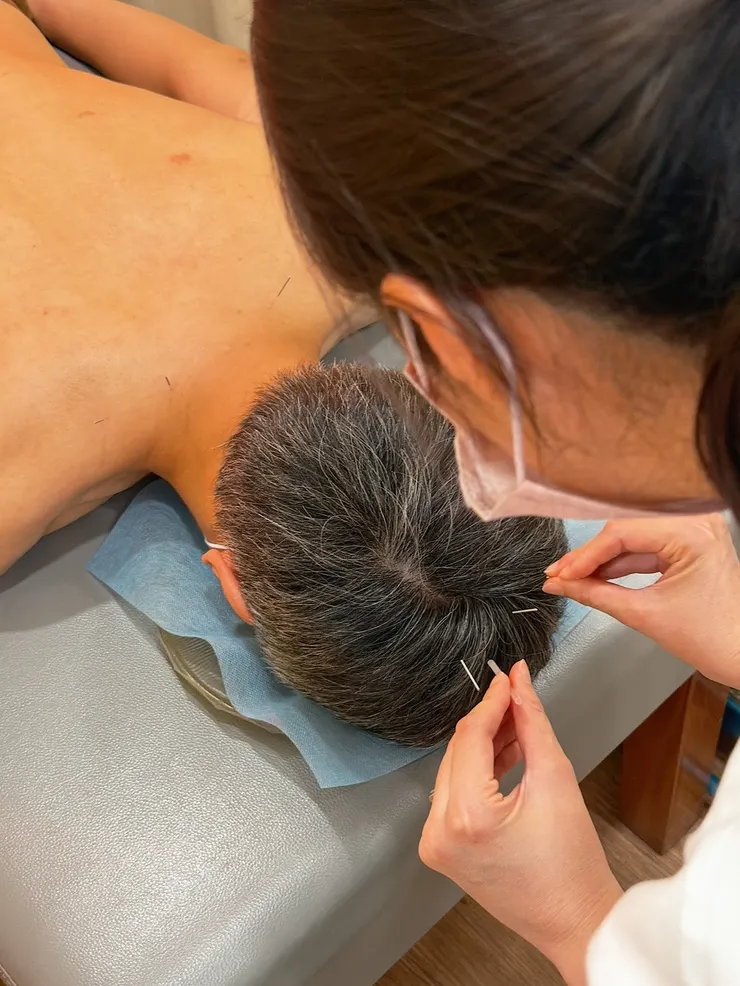 針對頭部穴位下針，能幫助放鬆緊繃的神經、提升睡眠品質。