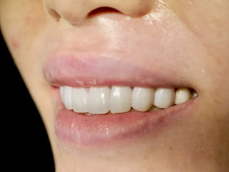 一笑傾城，氣質全開！客製化明眸鋯齒貼片(牙齒貼片)打造專屬你的自信笑容！