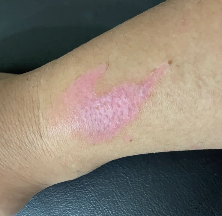 傷口好的飛快，新生了皮膚。