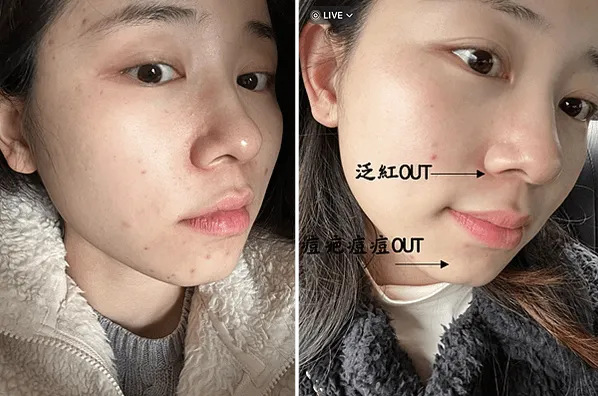 懷孕消痘疤推薦