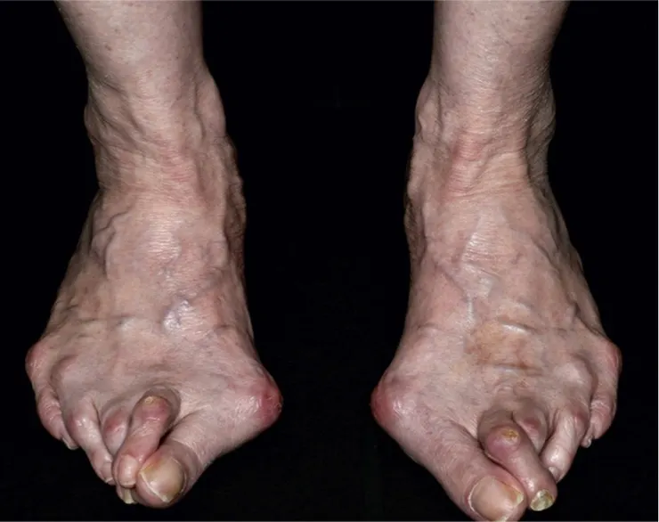 大腳趾與第二指重疊