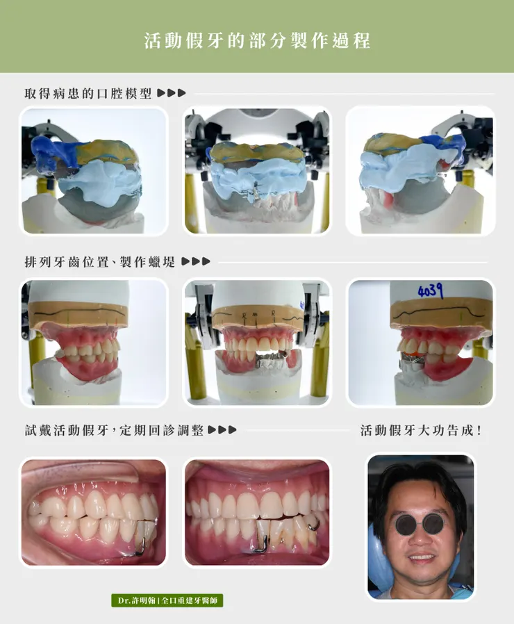 全口活動假牙的製作過程（部分）