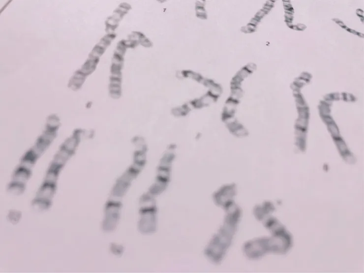 染色體檢查報告 by Ching