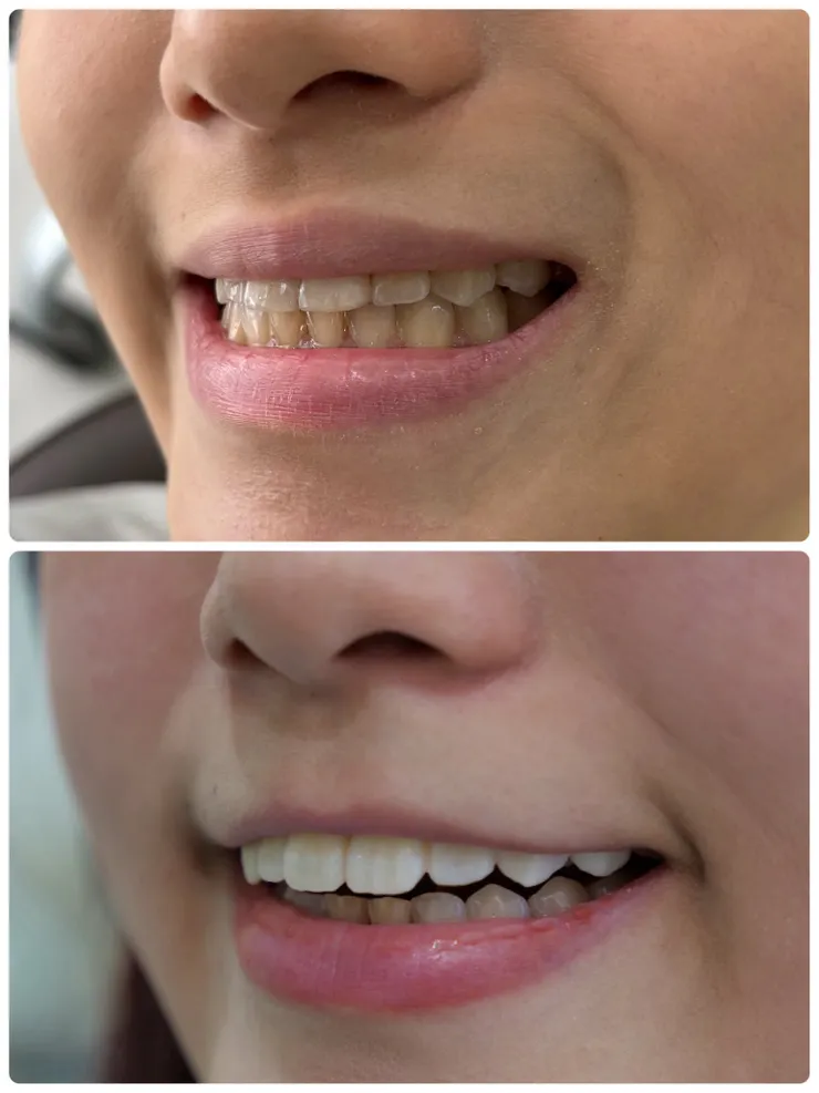 渥爾牙醫診所：大安區美學新標竿！渥爾牙醫4.0團隊，頂級美白牙齒貼片，打造完美笑容！