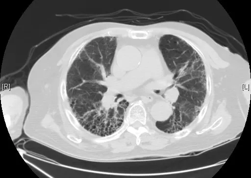 電腦斷層顯示蜂窩狀(honeycombing)變化病灶，看起來像菜瓜布一般。