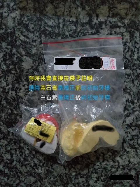 這是一般矯正石膏原始模，白石膏較硬，矯正較常使用