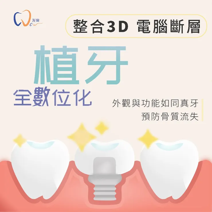 【全數位植牙新選擇】3D電腦斷層輔助，重拾自信笑容不再難！