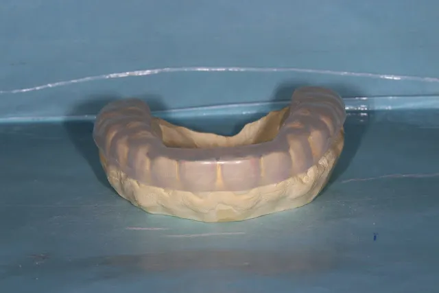 前診所製作的軟式咬合板（在牙模上）