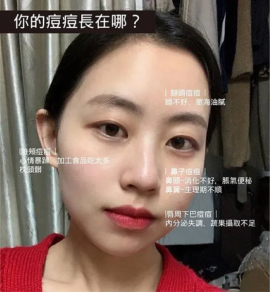 長痘痘位置代表什麼？