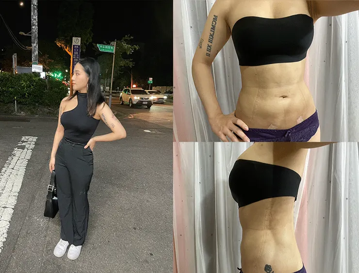 抽脂補胸 術後一個月