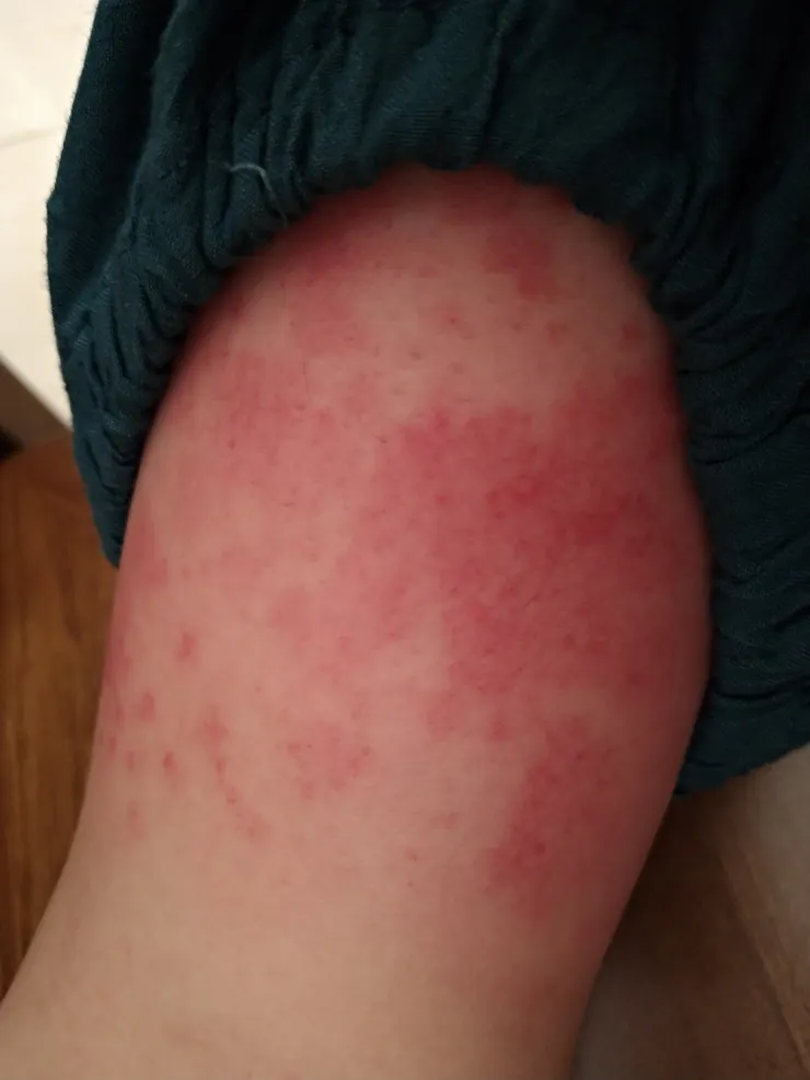 小編的貼布過敏腳