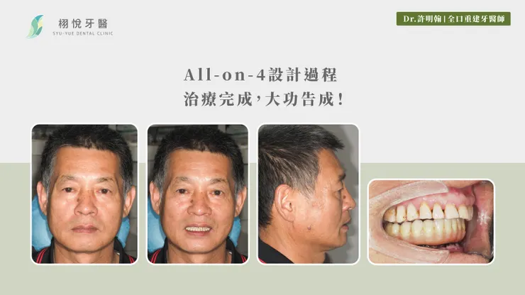 All-on-4設計過程：治療完成，大功告成！