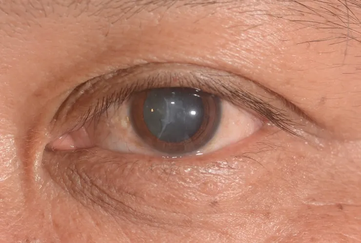 Diabetes-Related Cataract—Apollo Sugar