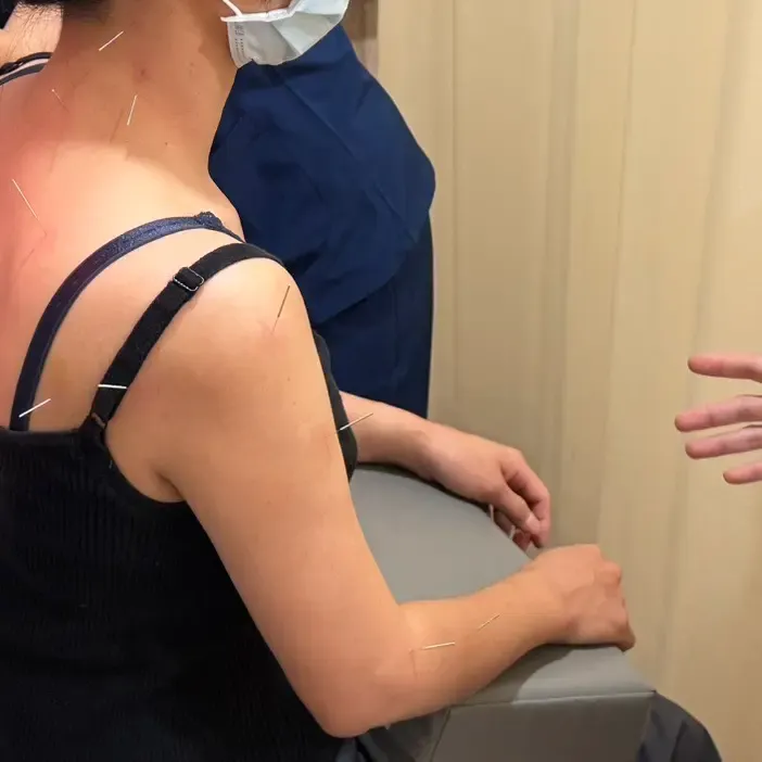 針灸治療中，感受那種酸酸麻麻的舒壓感。